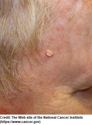 squamous cell carcinoma, skin cancer types, nursing nclex