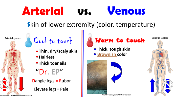 pad vs pvd, peripheral arterial disease, peripheral venous disease, peripheral vascular disease