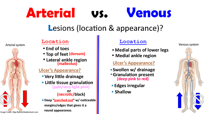 pvd, pad, arterial, venous, disease, peripheral arterial venous disease