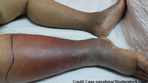 blood clot, signs and symptoms dvt, nursing