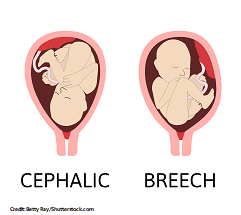 breech baby, cephalic position, vertex, pregnancy, maternity, nursing