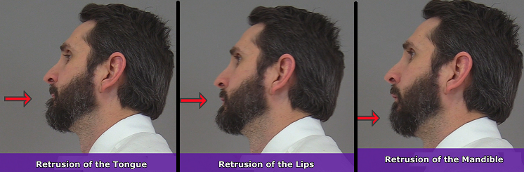 Retrusion of tongue, retrusion lips, retrusion mandible, retrusion anatomy