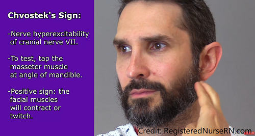 chvostek sign, hypocalcemia, signs symptoms, nursing, electrolytes, nclex