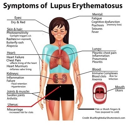 signs, symptoms, lupus, nursing, nclex, sle