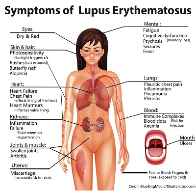 lupus, sle, nursing, quiz, questions, nclex, systemic lupus erythematosus