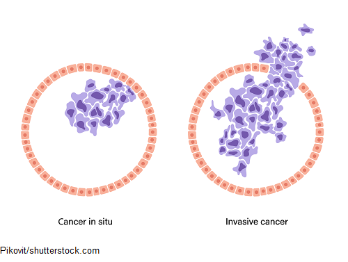 cancer, in situ, tumor system. tnm system, nclex