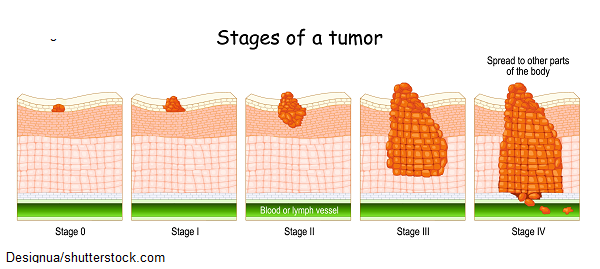 tumor staging, tnm, nursing, nclex