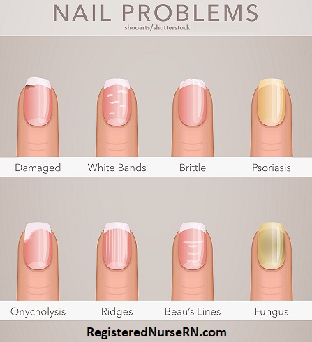 nail problems, nails sign of health, nail diseases, nail conditions
