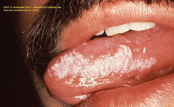 oral hairy leukoplakia, white hair on tongue, fur on tongue, hiv, aids, oral hairy leukoplakia picture