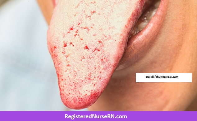 thrush, tongue, yeast, candida, white plaque tongue, white tongue