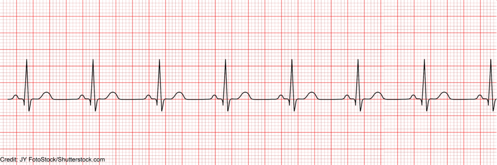 ecg, ekg, how to analyze a rhythm