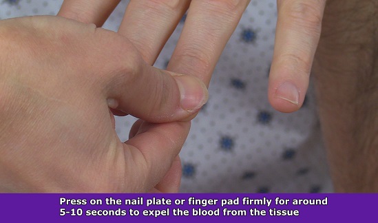capillary refill test, nail plate, press nail plate