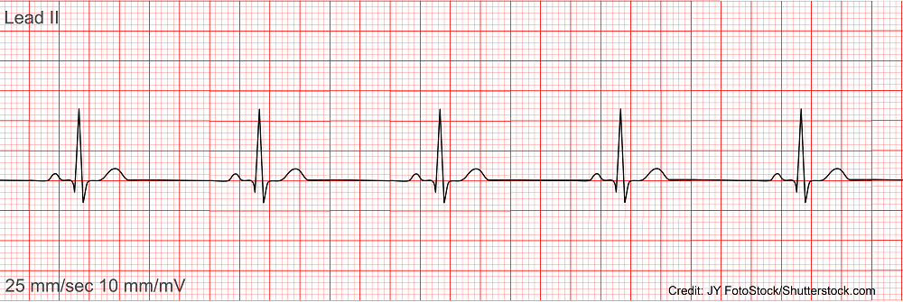 Sinus Bradycardia ECG/EKG NCLEX Quiz