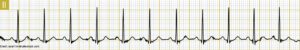 Sinus Tachycardia ECG/EKG Rhythm Nursing Review