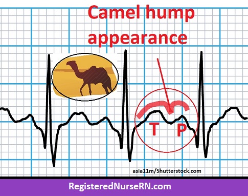 sinus tachycardia p wave hidden, camel hump, sinus tach