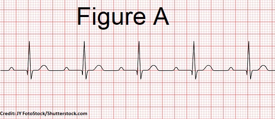 First-Degree AV Heart Block