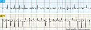 atrial fibrillation rapid ventricular rate RVR, a-fib, quiz, ecg, ekg, nursing