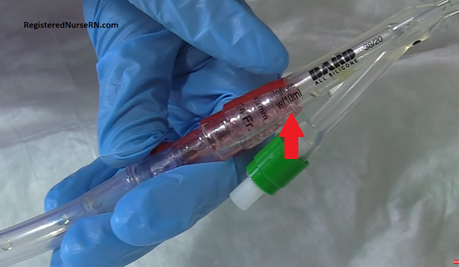 foley catheter water instillation port 10 mL, removed a foley catheter
