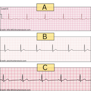 ecg quizzes, junctional rhythms, junctional escape, ekg interpretation