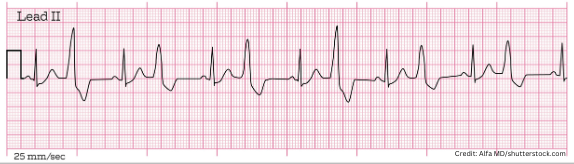 pvc, bigeminy, quiz, nursing, ekg, ecg